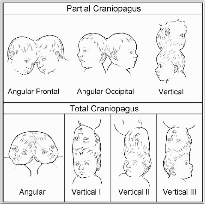 Craniopagus