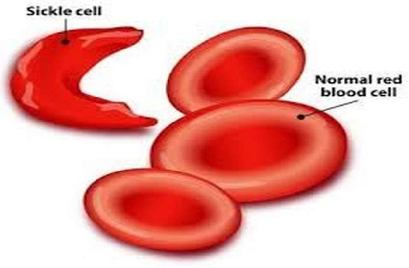 Sickle-cell